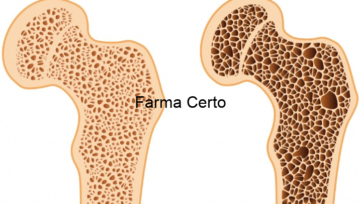 Osteoporose