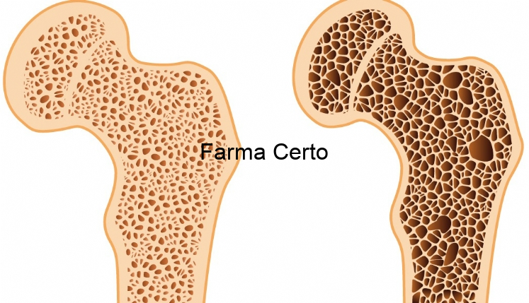 Osteoporose